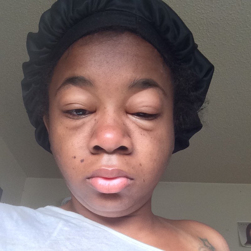 Why is your face swelling every morning?

It’s NOT ‘normal.’ It’s not stress. It’s not weather.
Sometimes it’s the first sign your organs are already struggling especially your kidneys.

Let me explain before it gets serious…