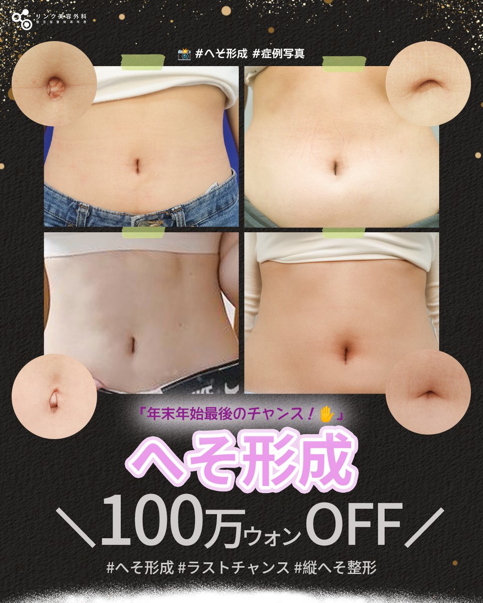 手術でもう失敗したくない」 その気持ちで来院される方が多いへそ形成