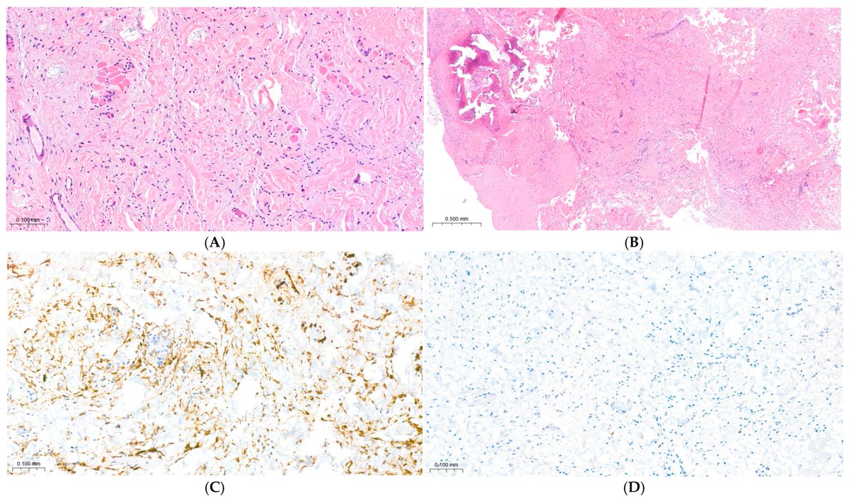 📜#mdpidermatopathology New Publication: Indeterminate Subcutaneous Lesion of the Nasal Dorsum in an Adolescent: A Multidisciplinary Approach to a Rare Case of Spindle Cell Lipoma 
by Alessandro Serrone et al.
#spindlecelllipoma 

🔗Access for free: mdpi.com/3573754