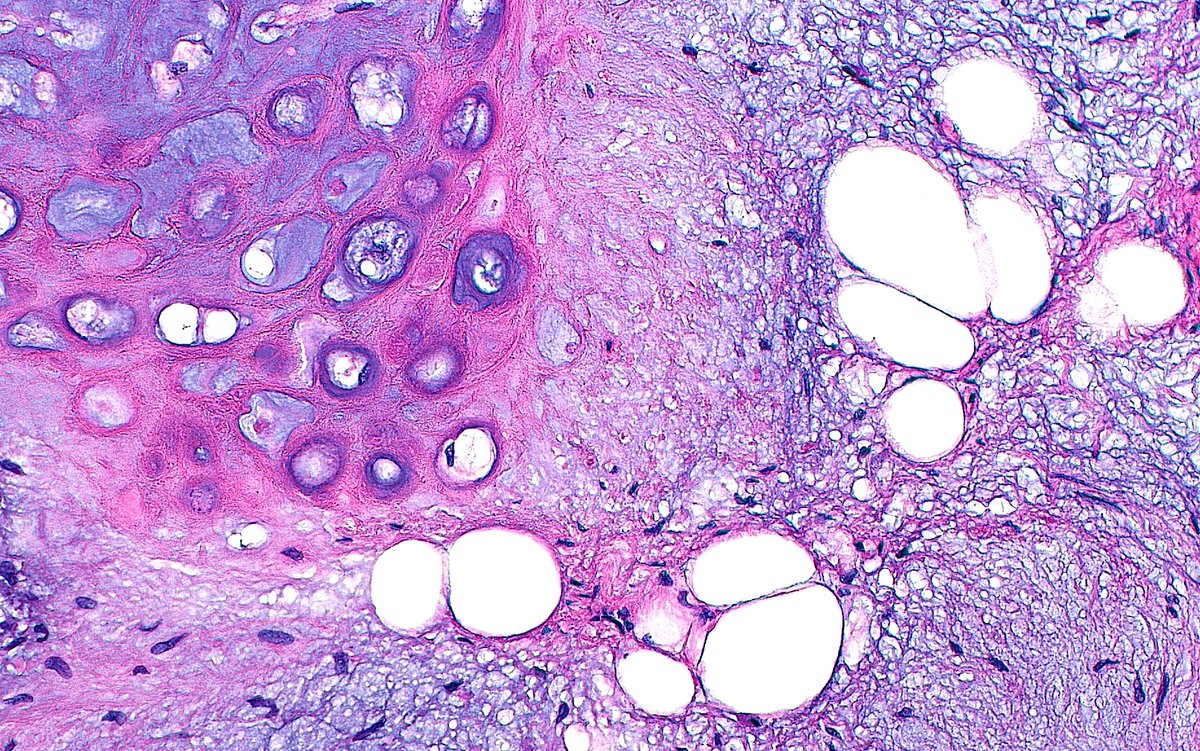 ziad_zaatari's tweet image. 🔬📸  Pulmonary Hamartoma ~ 3 in 1... Cartilage (left), fat (white), and myxoid spindled cells (light blue) ~ #PulmPath #Pathology #PathArt