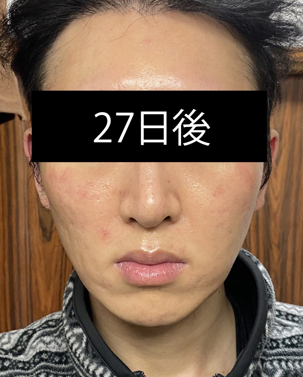 tkitokun's tweet photo. 18/n
27日後
前日のピーリングの影響で、顔が赤いが気にしないでくれ・・・。
そして、睡眠不足で肌の調子が悪い。

まだジョール除去部分が拘縮中で固い。
これ、たぶん一ヶ月くらい固いままなんじゃ？？？と思い始める。
たまに揉んでマッサージしている。 https://t.co/7Y7iOwqV4P