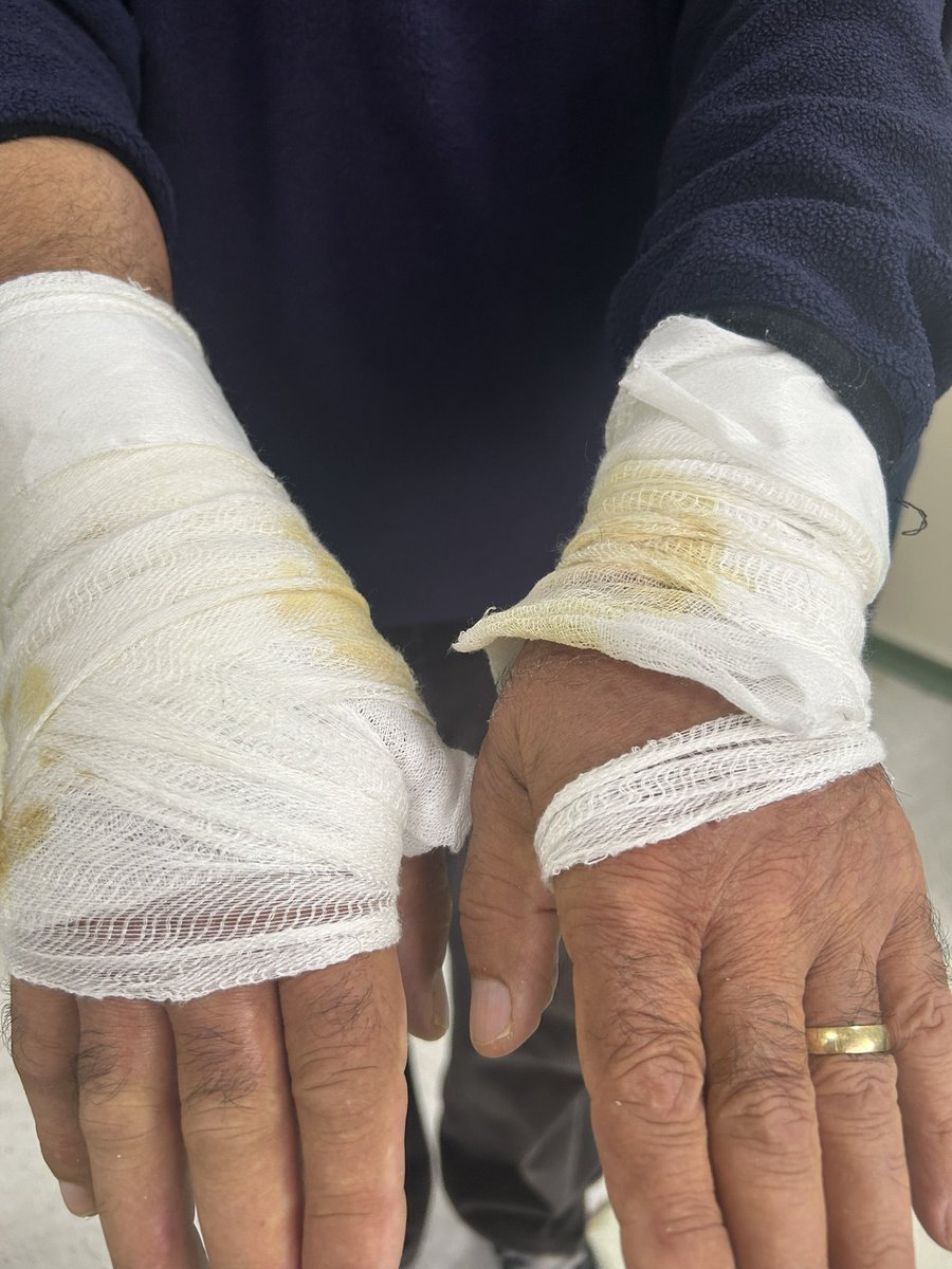 Siz sadece köpek ısırmasından kuduz olanların haberini duyuyorsunuz, bizler yüzlerce köpek tarafından ısırılanları, ısırılıp tekerlekli sandalyeye mahkum olanları, aylarca iyileşmeyen yaraları yüzünden yaşam kalitesi düşenleri görüyoruz, bunlar haber bile olmuyor.