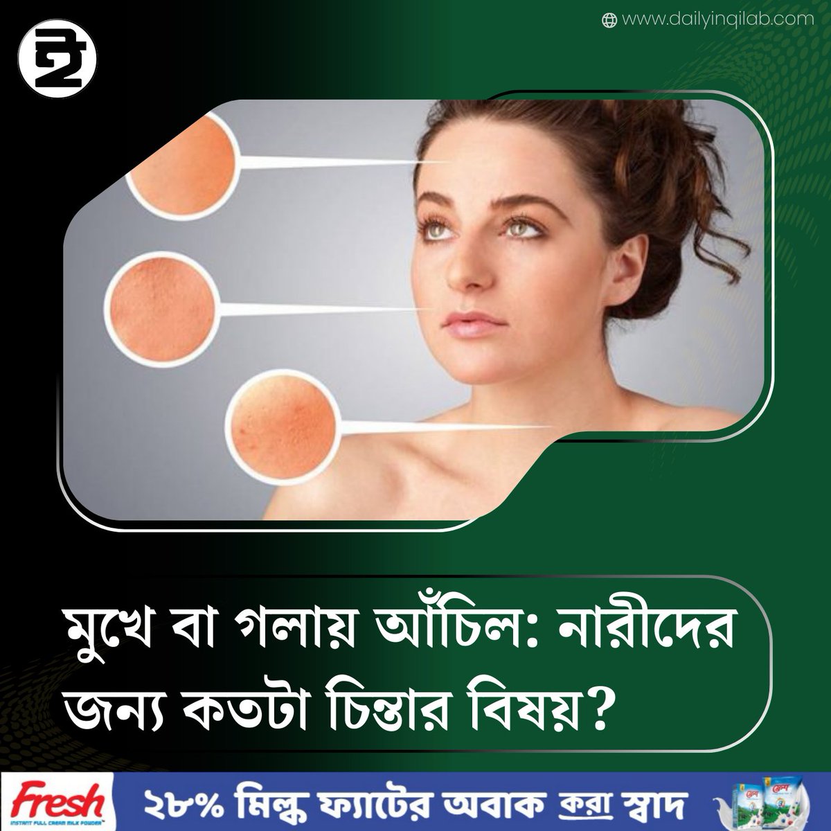 TheDailyInqilab's tweet image. মুখে বা গলায় আঁচিল: নারীদের জন্য কতটা চিন্তার বিষয়?
dailyinqilab.com/lifestyle/news…