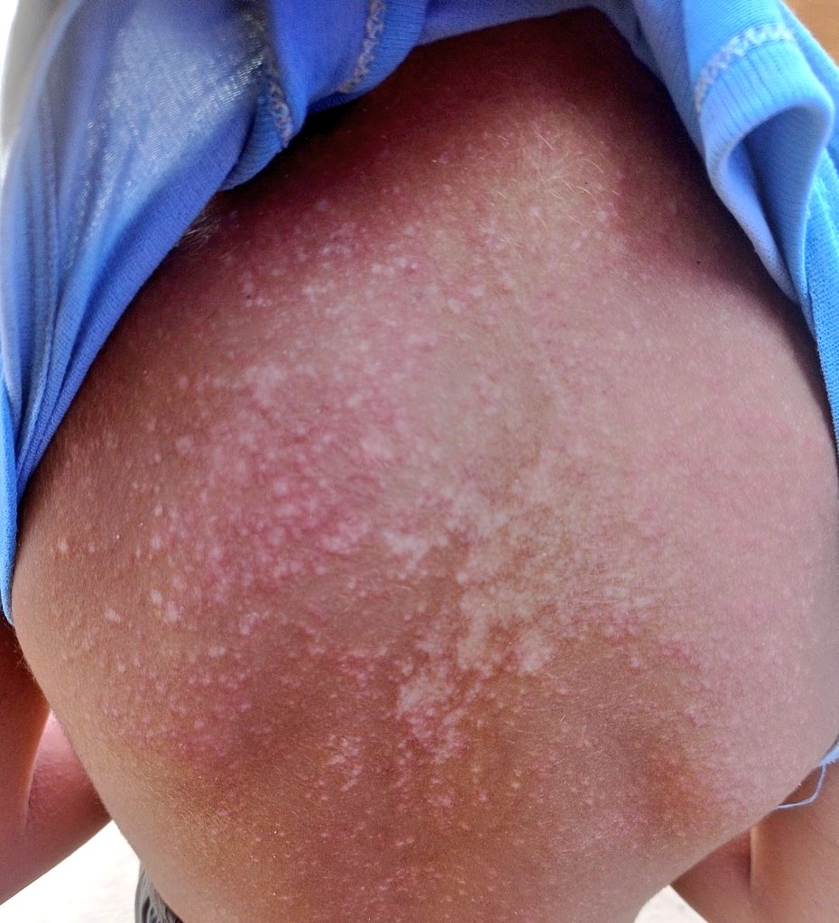 _nesmam's tweet photo. My little bro's body is covered in blisters he cries from the pain &amp; can't even sleep on his back. The pain is consuming his small body &amp; he's been isolated from the other children cuz it's contagious

 pls donate and leave a dot
https://t.co/aP7SS6a5M0
Or
https://t.co/hSrSYZzfiH https://t.co/RK2pynLTbk