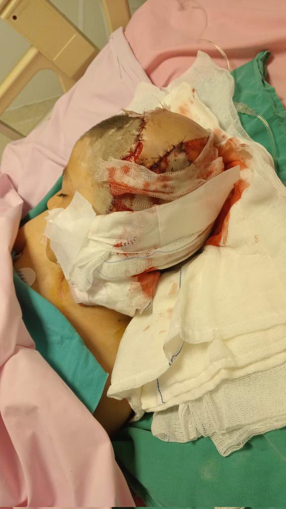 ‼️HASSAS

Bugün Tunahan’ın başına gelenlerin, 20 başıboş köpek tarafından parçalanmasının, hayatının gasp edilmesinin kısacası ömrüne biçilecek tazminat davasının karar duruşması vardı…

Yutkunarak, gözlerimin dolmasını engellemeye çalışarak hakkı için beyanda bulundum…

Karar