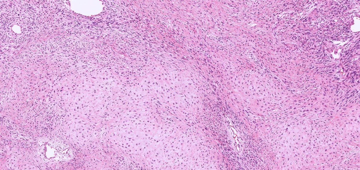 RunjanChetty's tweet photo. Soft tissue tumour deep thigh. What is the first image demonstrating? @diagnexia @DrGeeONE @drtimbracey @ariella8 @smlungpathguy @slusagar https://t.co/RaVpPbZt2X