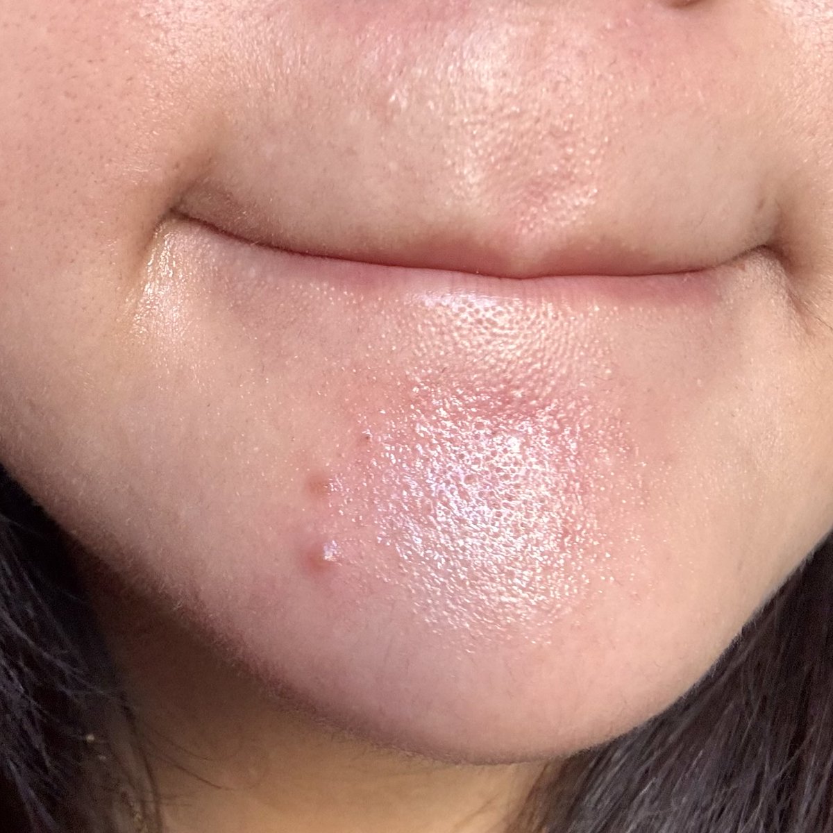 lisabubblegummy's tweet photo. เป็นสิวผิวแดงระคายเคืองกลับมาซบ La Roche-Posay เท่านั้นน! 

- Effaclar duo+M ม้อยส์สำหรับคนเป็นสิว ตัวนี้ช่วยลดปัญหาสิว มี Phylobioma และ LHA ช่วยจัดการต้นตอการเกิดสิว ลดการเกิดสิวซ้ำซาก คนผิวมันใช้ได้ตัวนี้ช่วยลดความมันส่วนเกิน เนื้อบางเบา ทาเช้า-เย็นได้เลย สิวแห้งเร็วกว่าเดิม

- Effaclar H ISO-BIOME ตัวนี้เป็นม้อยส์ที่เติมความชุ่มชื่นให้ผิว ลดการอักเสบของผิว สามารถใช้เป็นมอยส์คุมสิวต่อเนื่องได้เลย ตัวนี้ตอนที่เราเป็นสิวตรงจมูกแห้งลอกเป็นขุยๆ ทาตัวนี้ทาก่อนนอนตื่นมาจมูกไม่แห้งแล้ว ช่วยปรับสมดุลผิวไปในตัว ผิวชุ่มชื่นสุขภาพดีขึ้น อากาศหนาวใช้ตัวนี้คือเหมาะมาก