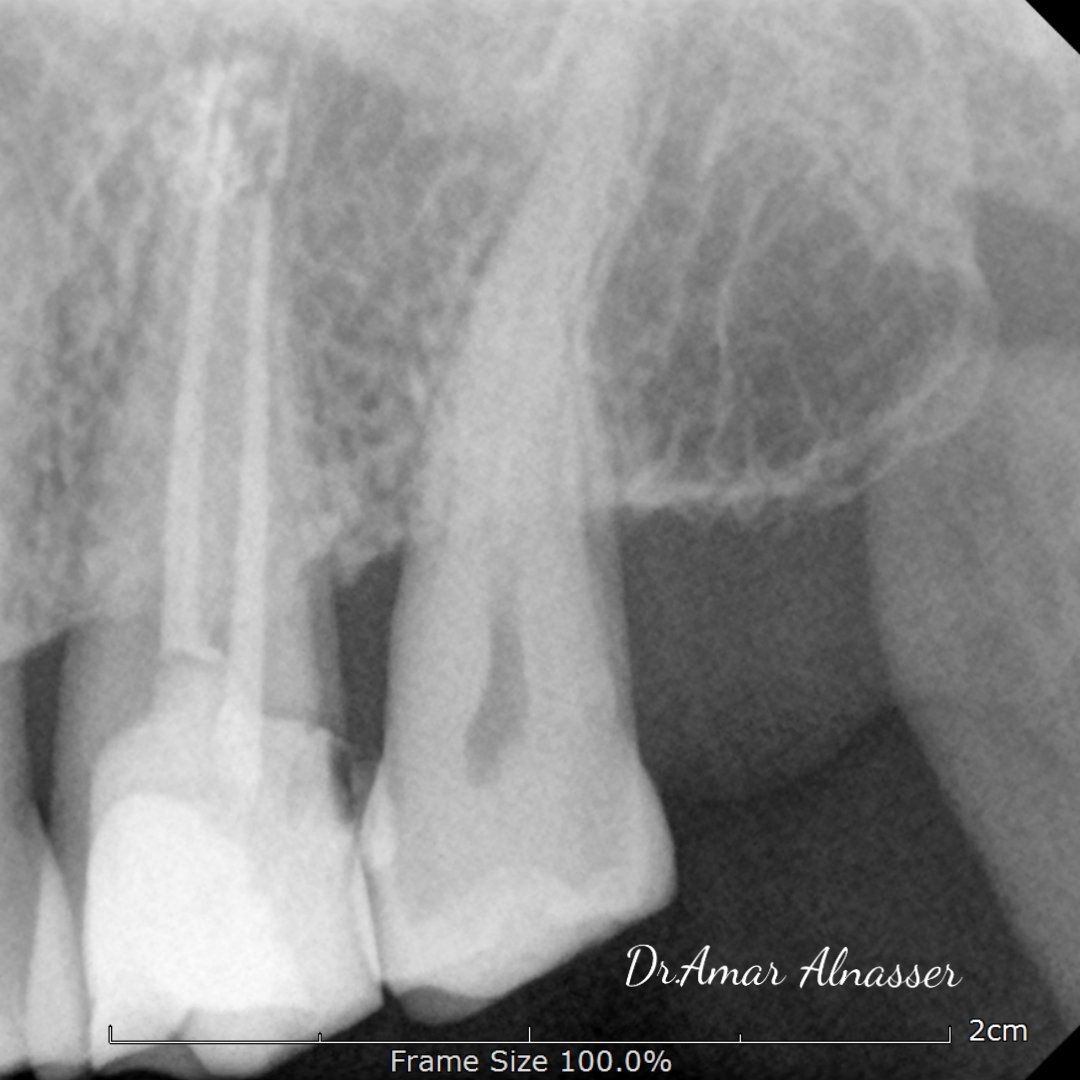 dentist_amar617's tweet image. علاج  عصب لطاحن علوي  مسبب الم 
تم تحت العازل المطاطي وثم عمل حشوة دائمة تجهيزا لعمل تلبيسة
Rct for #27 with unusual anatomy of root
Prepared using v taper gold and filled Gp and bioceramic  sealer 
#saveatooth #endodontics #سماء_الفن
Final result down
