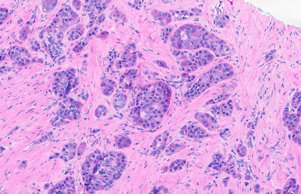 rovingatuscap's tweet image. Excellent example of #prostatecancer with coarse eosinophilic granules (so-called &apos;Paneth cell-like&apos; change; **unlike Paneth cells of GI tract, these cells DO NOT contain lysozyme and DO express neuroendocrine markers) - can be seen in both primary &amp;amp; post-treatment specimens👇🏻