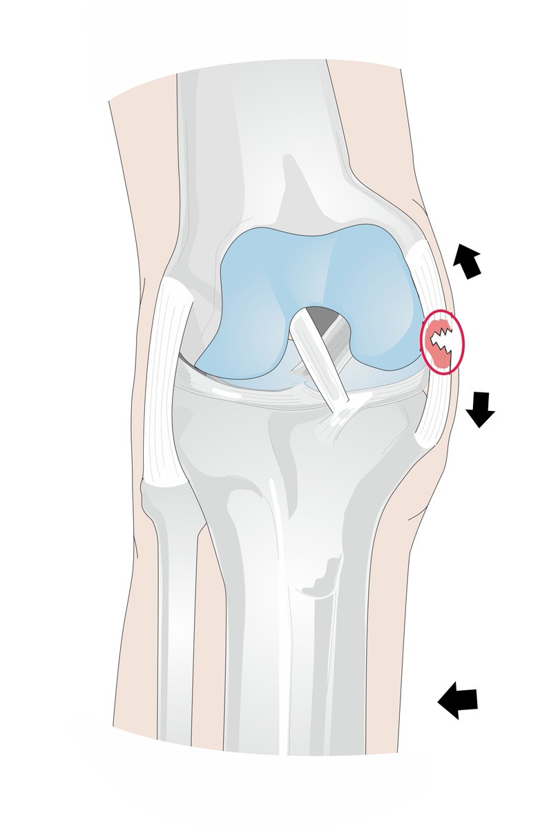 DrJesseMorse's tweet image. Will Campbell update: 

MCL sprain confirmed 

Sounds more moderate (partial tear, grade 2) than mild (grade 1). 

MRI (presumably this morning) will confirm specifics, which include severity of injury to MCL, location (usually proximal MCL), any injury to (medial) meniscus and…