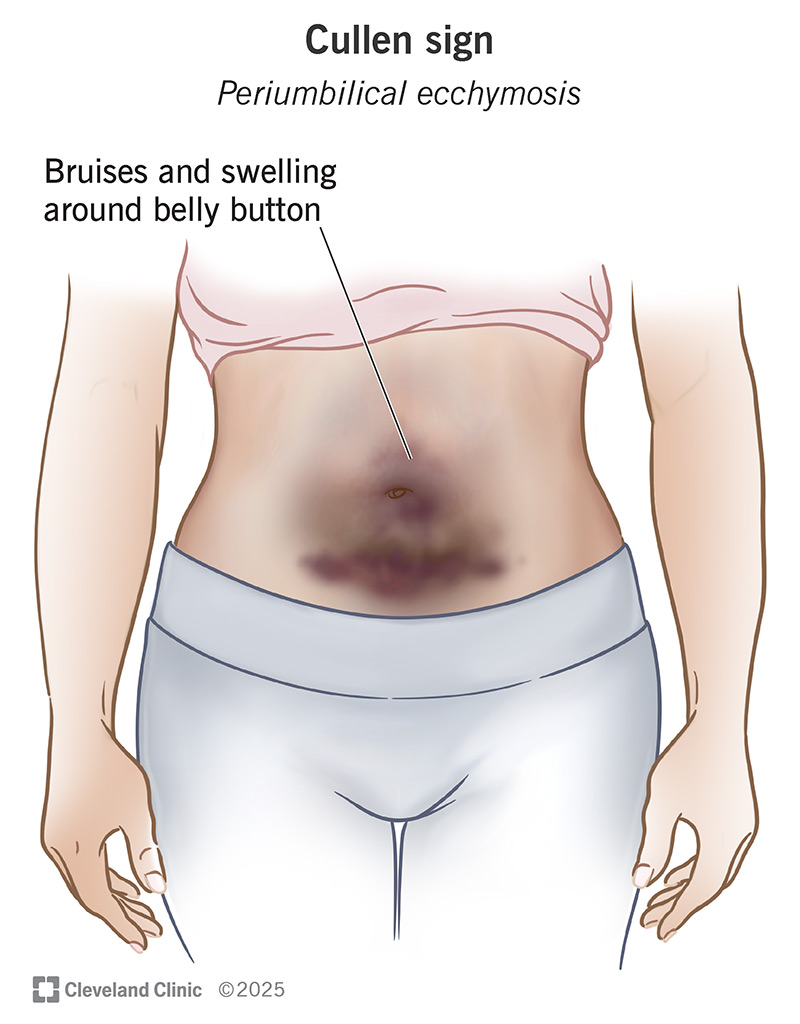 TrackYourHeart's tweet image. A patient develops ecchymosis around the umbilicus two days after severe acute abdominal pain. Which condition is this sign most associated with?
A. Ruptured spleen
B. Hemorrhagic pancreatitis
C. Liver laceration
D. Renal artery thrombosis