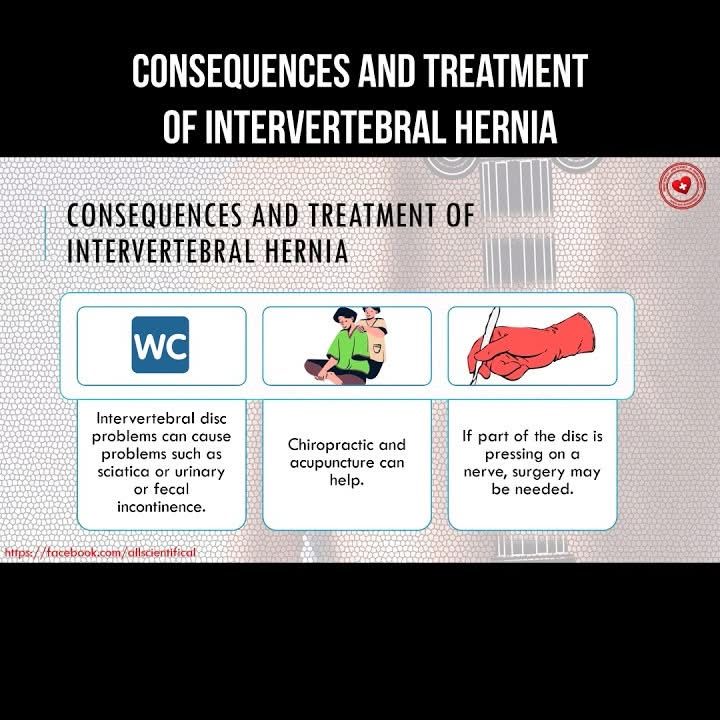 AllScientifical's tweet image. Consequences and treatment of intervertebral hernia #spine #spinetreatment #hernia #backpain
 ... Continue to: youtube.com/shorts/CMXbce1…