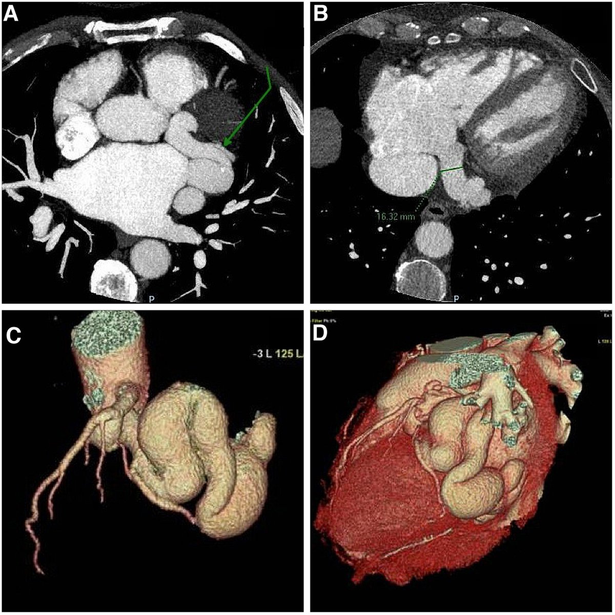 Between atrial fibrillation and ablation: an unexpected finding #REC. revespcardiol.org/en-between-atr…