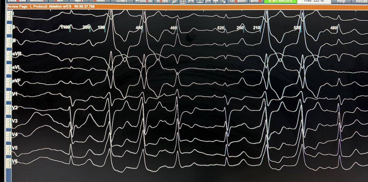anunay_cardio's tweet image. 18/male. Normal LV. Where will u find the focus?