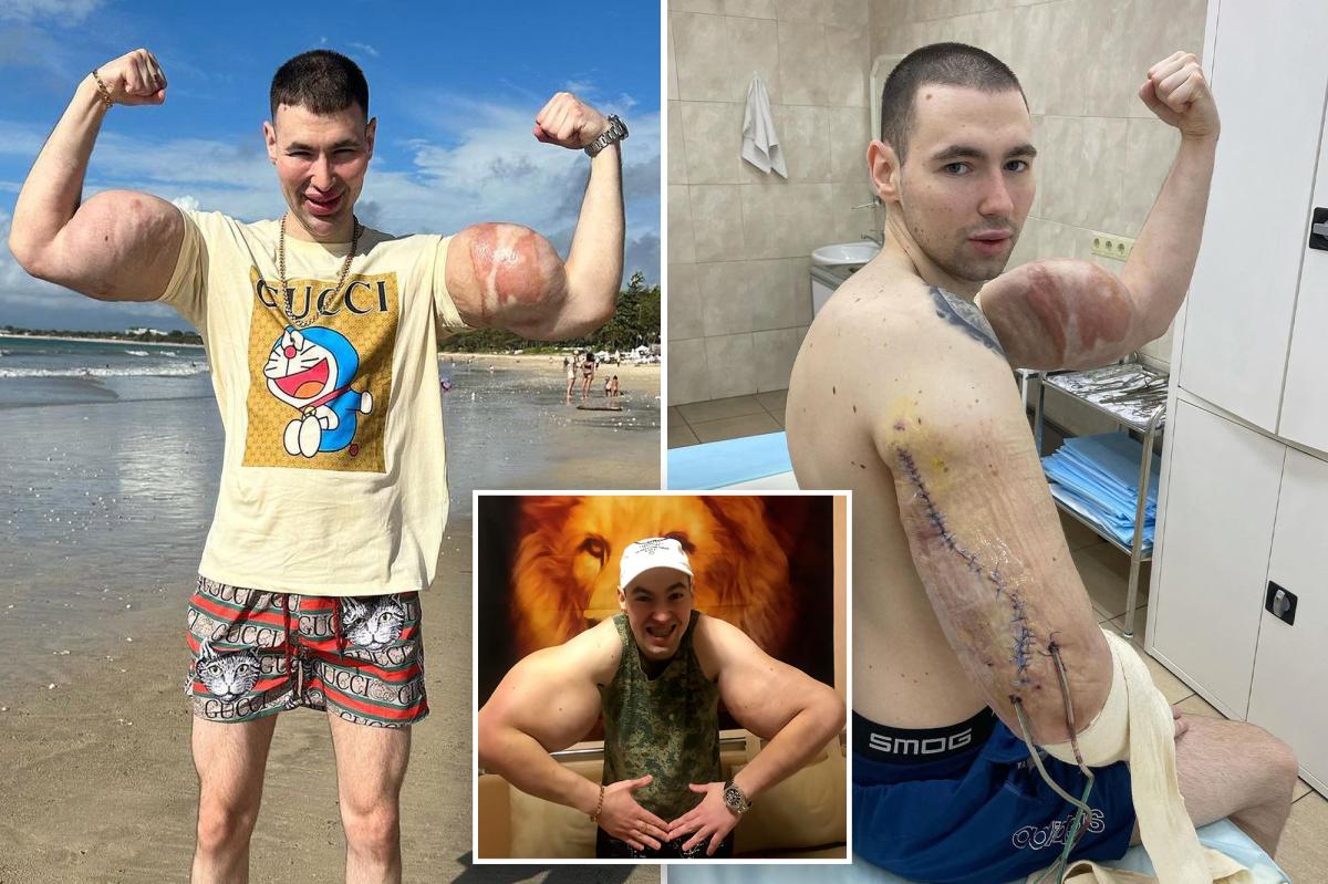 nypost's tweet image. Russian ‘Popeye’ who injected his biceps to grow freakishly big could now lose both arms to gruesome infection trib.al/hiFzuSF