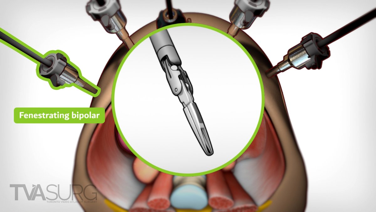 pizawL's tweet image. Color-coded outlines on the robotic surgical tools is a little detail I add to help the viewer compartmentalize the information being presented. This one is a bipolar cautery tool.

#RoboticSurgery #MedicalDesign #VisualCommunication #SurgicalEducation #NarrativeDesign
@TVASurg