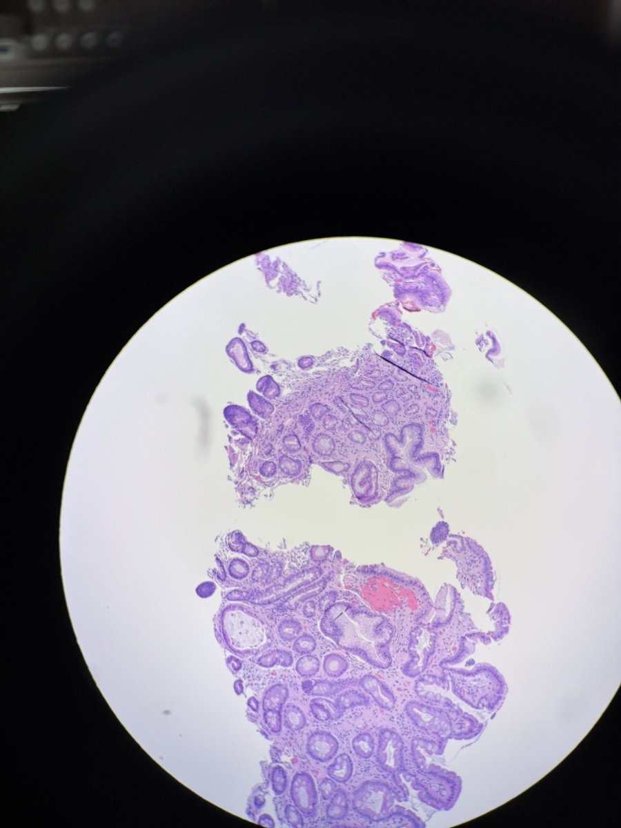 PathServerUS's tweet image. Is this metaplasia or normal?