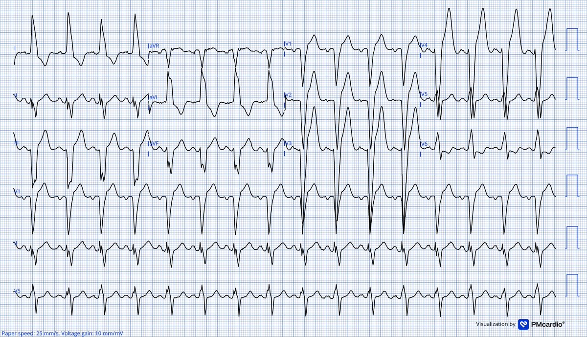 MubarakAlhatemi's tweet image. A woman in her 50s with chest pain and high blood pressure 170/90 mmHg.
The LBBB is new.
Cath lab or troponin/echo
Digitalized using the Goat 🐐 app 
@PMcardioApp