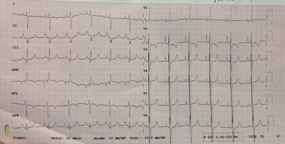 josecruz2102's tweet image. ✅Male, 19 y/o. 34% LVEF✅

🫀ALCAPA Sx🫀

#Cardiology #rhythm #ECG #EPeeps