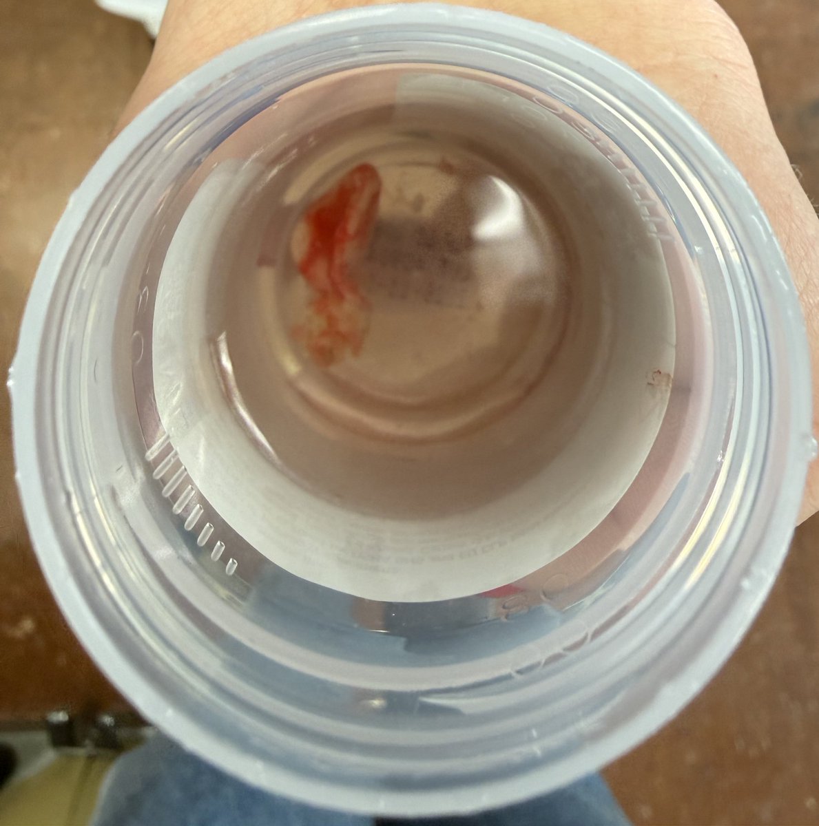 CuseJerseys44's tweet image. Dr Pimple Popper type surgery today. One lump down, five to go. Lump number two, the biggest one I have, will be removed tomorrow.