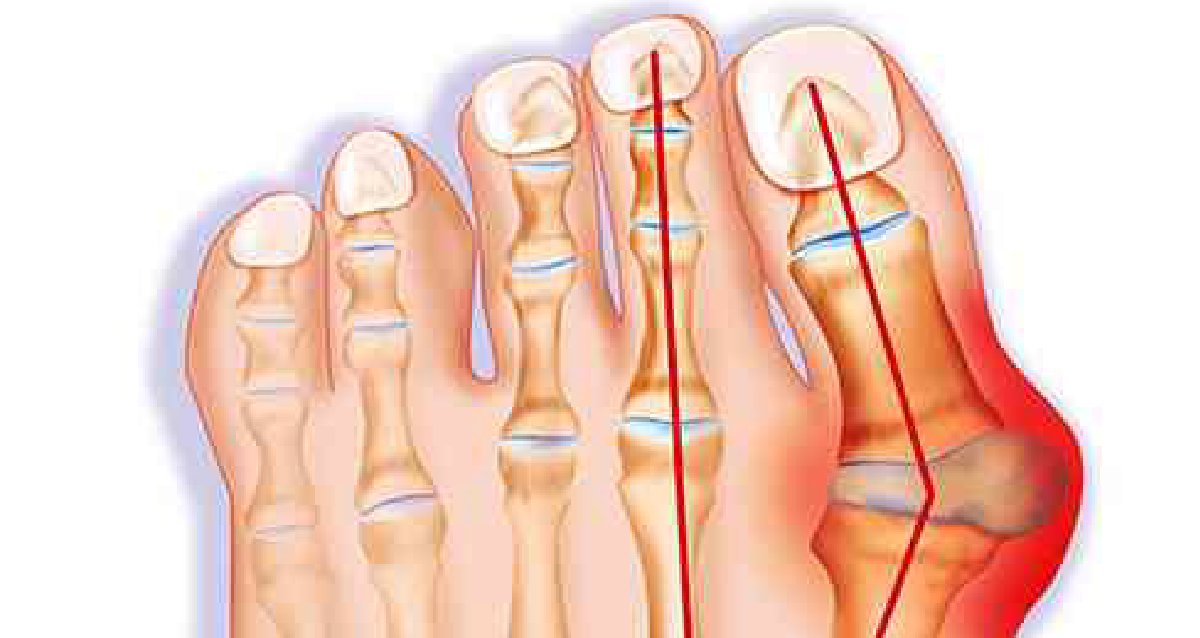 WebMD's tweet image. Bunions are painful bony lumps that grow along the inside of your foot at the joint where your big toe meets your foot -- they grow slowly as the big toe angles inward. Find out more: wb.md/4pufj3d