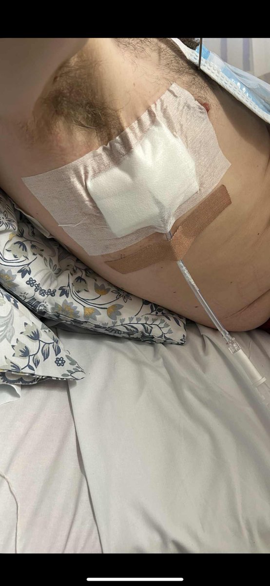 calotelli45's tweet image. went to share my story &amp;amp; hopefully raise awareness with you all :

As some of you may or may not know last week I suffered 3 broken ribs &amp;amp; a punctured lung playing the sport I love. ⚽️ 

However when in hospital I suffered complications with my heart which led to me having a…