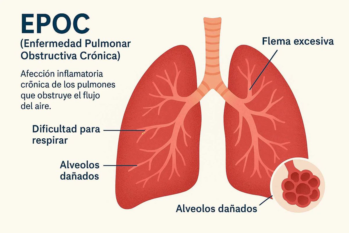 En Ferrol, el 70% de los pacientes con Enfermedad Pulmonar Obstructiva Crónica ni siquiera saben que la padecen. La EPOC ya es la tercera causa de muerte en el mundo y avanza silenciosamente: tos crónica, falta de aire y fatiga…