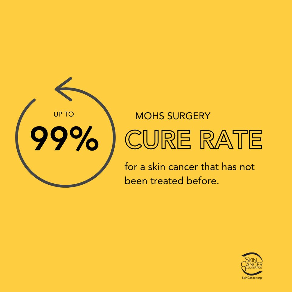 SkinCancerOrg's tweet image. Mohs surgery is considered the most effective technique for treating many basal cell carcinomas (BCCs) and squamous cell carcinomas (SCCs), the two most common types of skin cancer. skincancer.org/treatment-reso…  #Mohs #MohsSurgery #SkinCancerProcedure