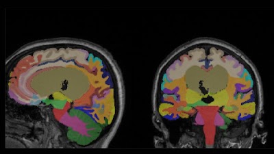 Radiology_AI's tweet image. 🧠 DLMUSE achieves rapid, robust #brain MRI segmentation with high accuracy (Dice scores: 0.84–0.89). #OpenSource &amp;amp; user-friendly! doi.org/10.1148/ryai.2… @Penn #segmentation #AI #MachineLearning
