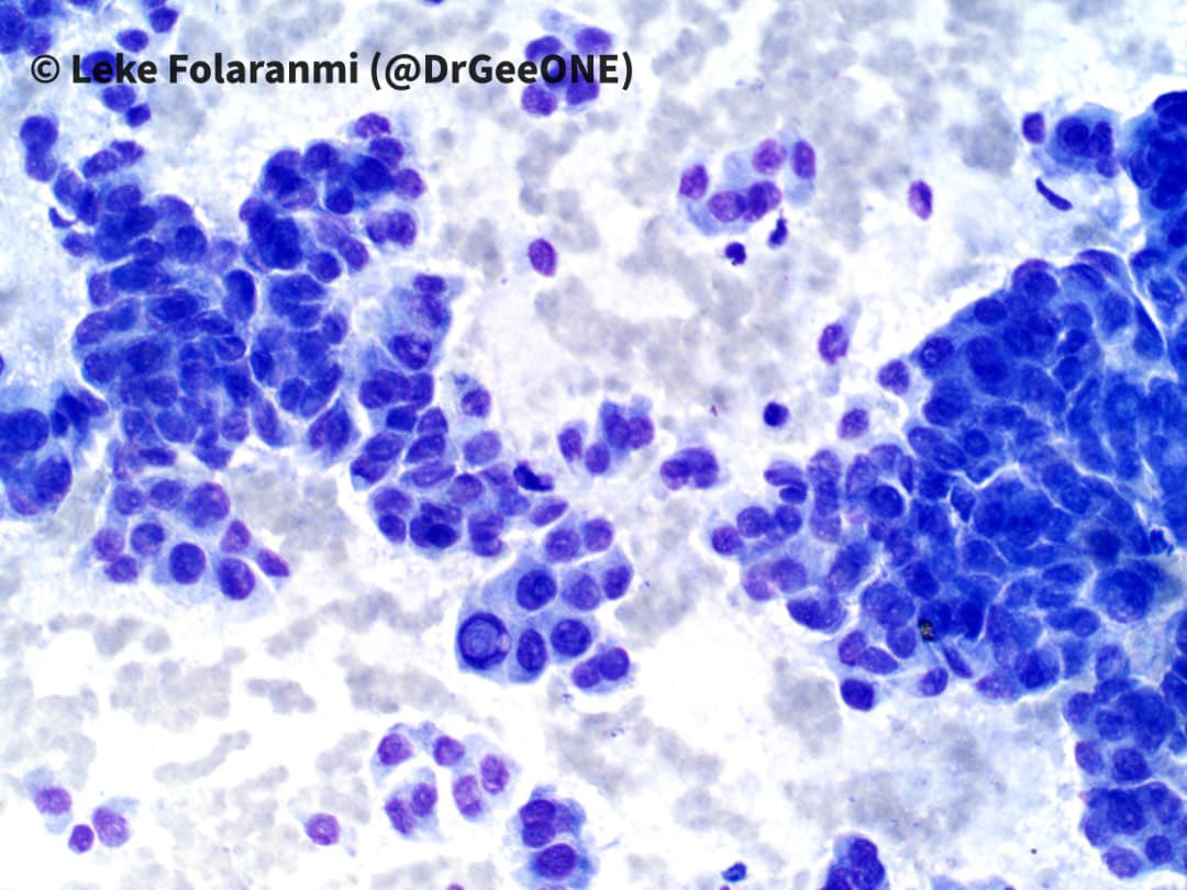 DrGeeONE's tweet image. Papillary Thyroid Carcinoma
-Bringing back this Classic!

#Cytopath #Thyroid #Pathology 
@RunjanChetty @MirunaPopescu13 @SumantaDas_7 @ariella8 @TotalCytopath @pepeheffernan @mdlozanoe @AnupamaArya12 @smlungpathguy @Sara_Jiang @VarshaManuchaMD @edusqo @chriszioga