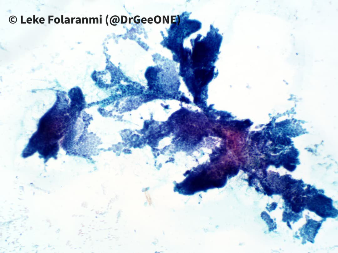 DrGeeONE's tweet image. Papillary Thyroid Carcinoma
-Bringing back this Classic!

#Cytopath #Thyroid #Pathology 
@RunjanChetty @MirunaPopescu13 @SumantaDas_7 @ariella8 @TotalCytopath @pepeheffernan @mdlozanoe @AnupamaArya12 @smlungpathguy @Sara_Jiang @VarshaManuchaMD @edusqo @chriszioga