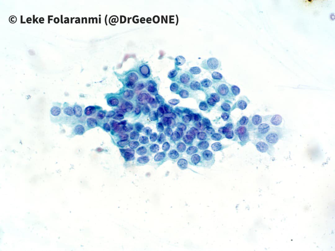 DrGeeONE's tweet image. Papillary Thyroid Carcinoma
-Bringing back this Classic!

#Cytopath #Thyroid #Pathology 
@RunjanChetty @MirunaPopescu13 @SumantaDas_7 @ariella8 @TotalCytopath @pepeheffernan @mdlozanoe @AnupamaArya12 @smlungpathguy @Sara_Jiang @VarshaManuchaMD @edusqo @chriszioga