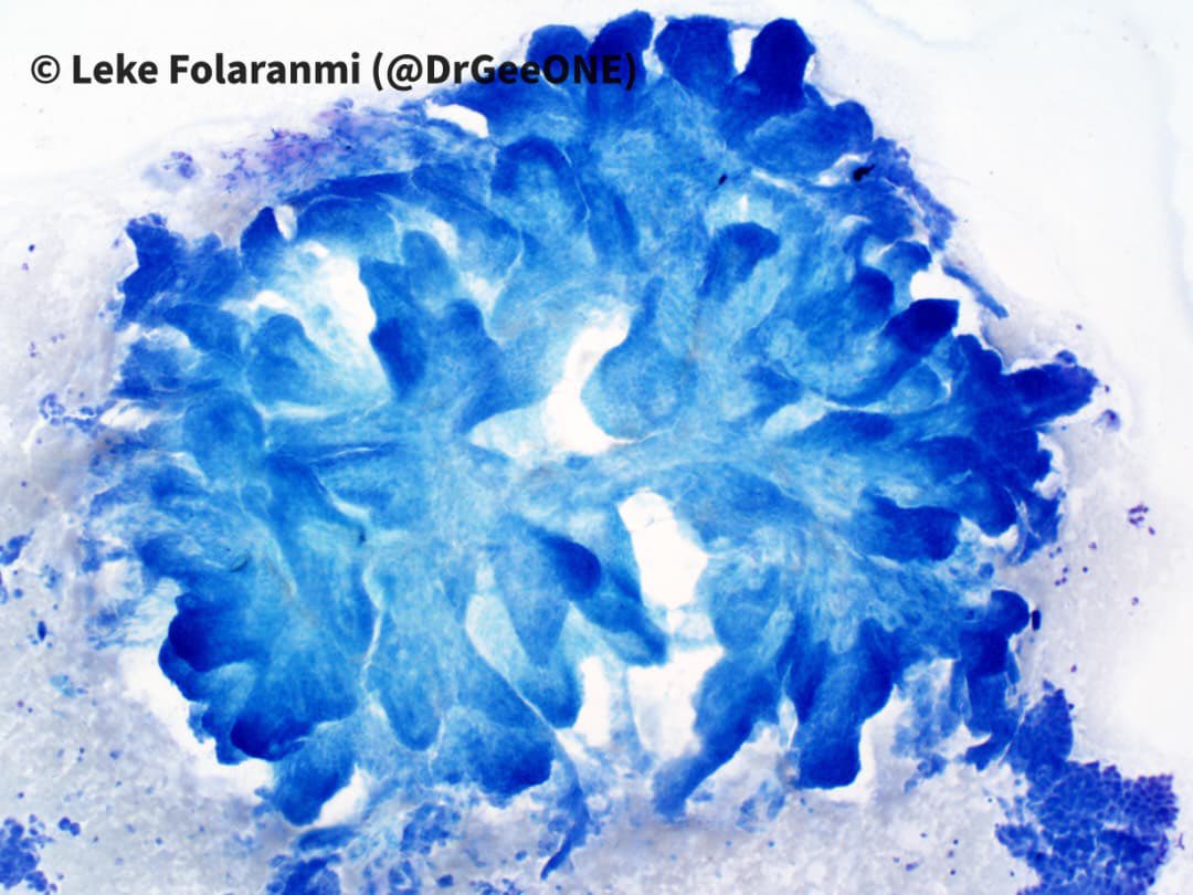 DrGeeONE's tweet image. Papillary Thyroid Carcinoma
-Bringing back this Classic!

#Cytopath #Thyroid #Pathology 
@RunjanChetty @MirunaPopescu13 @SumantaDas_7 @ariella8 @TotalCytopath @pepeheffernan @mdlozanoe @AnupamaArya12 @smlungpathguy @Sara_Jiang @VarshaManuchaMD @edusqo @chriszioga
