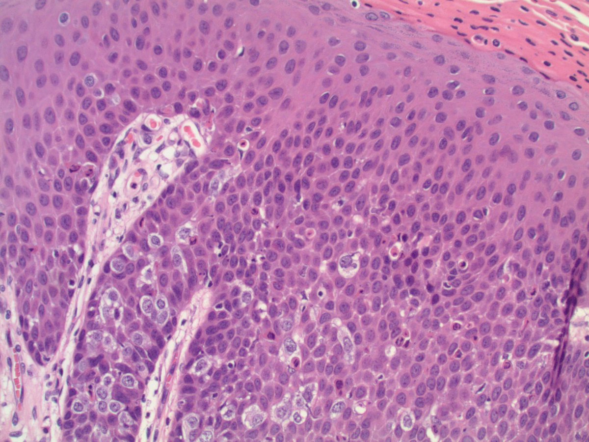 #GUpath bladder lesion, TURBT:

keratinizing squamous metaplasia (itself a risk factor for disease progression)➕urothelial carcinoma in situ (Pagetoid pattern)
