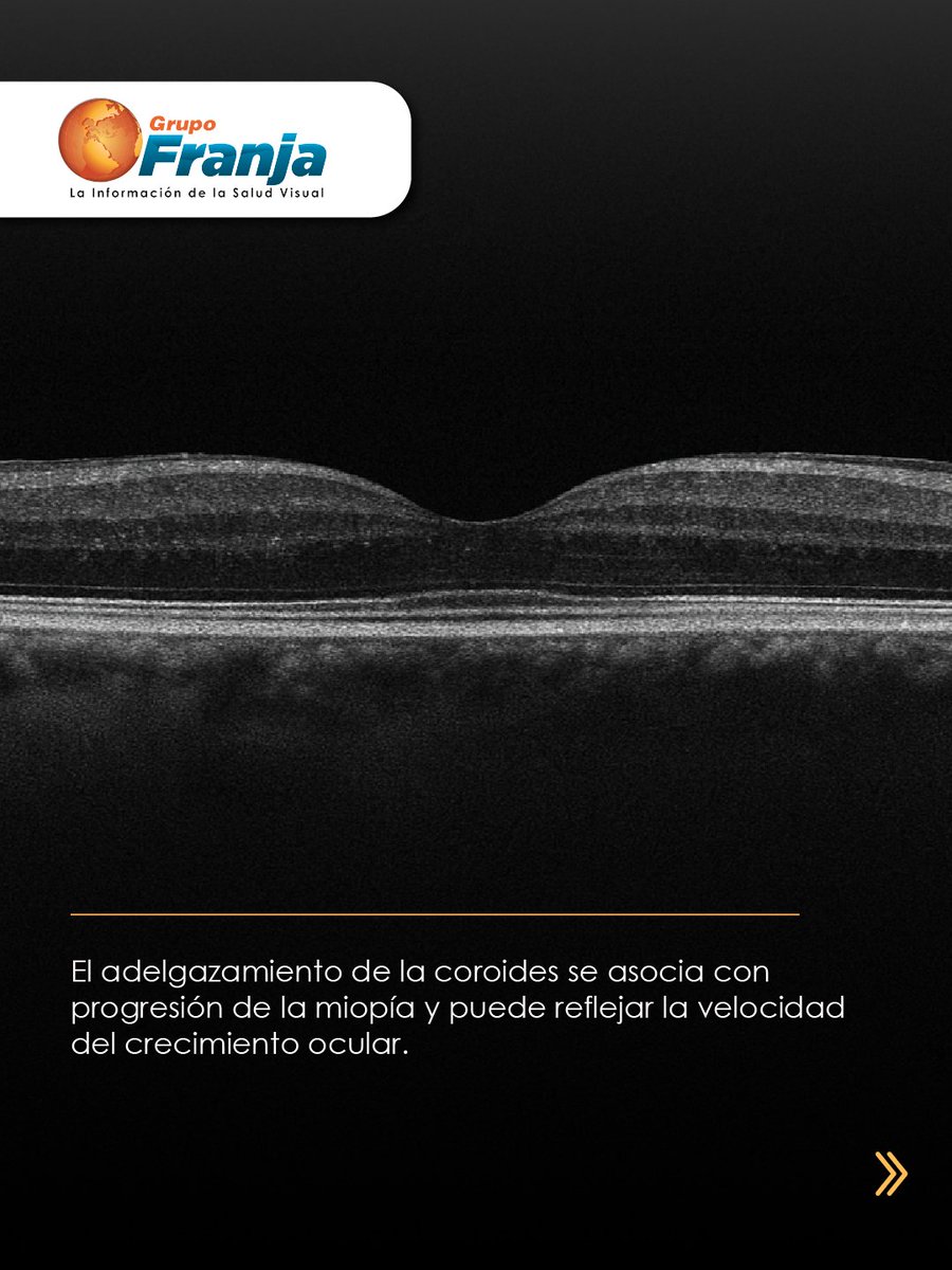 FranjaVisual's tweet image. La coroides podría ser un biomarcador del crecimiento ocular. Estudios recientes muestran que OK y OK + atropina se relacionan con aumentos en su espesor, un hallazgo clave en control de miopía.

👉🏾 f.mtr.cool/pverwixjdt 👈🏾

#NotasFranja #Lentes #SaludVisualConEstilo