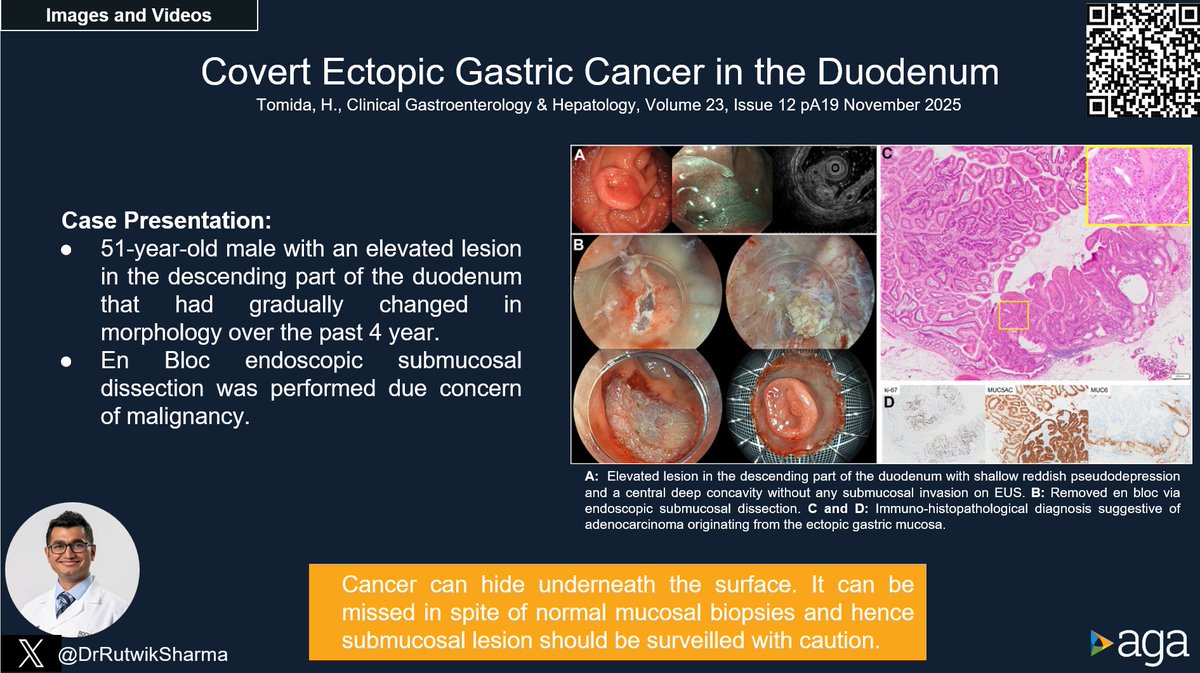 JosephHabibi_MD's tweet image. #CGH4ALL @AGA_CGH 📣

What do you do w/ an elevated lesion in the duodenum?

#ESD #Endoscopy #GIcare #GITwitter

🌐cghjournal.org/article/S1542-…

Reported 📢@DrRutwikSharma

@EndoTx,@DouglasAdlerMD,@DennisYangMD, @BilalMohammadMD, @JennPhanMD, @allie_schulman, @VinayChandraMD,