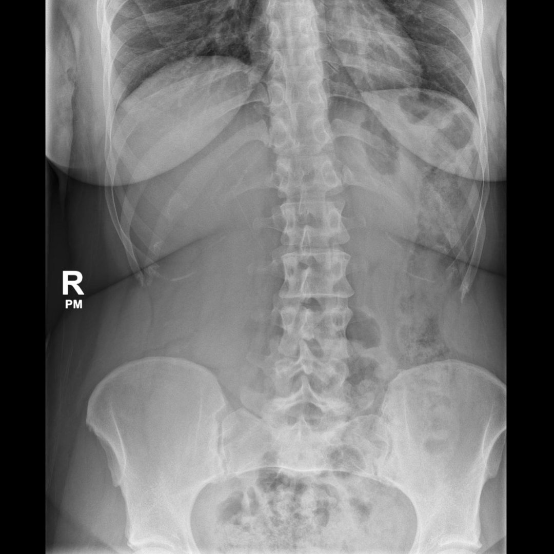 Anything wrong with this KUB? Are you able to guess what's going on?

<a href="/BrighamRad/">Brigham and Women's Radiology</a> <a href="/FOAMrad/">FOAMrad</a> <a href="/SAR_RFS/">SAR Resident and Fellow Section</a> <a href="/futureradres/">Future Radiology Residents</a> <a href="/ARRS_Radiology/">ARRS</a> <a href="/Abdominal_Rad/">Abdominal Radiology</a> <a href="/CBRadiologia/">CBR</a> #MedEd