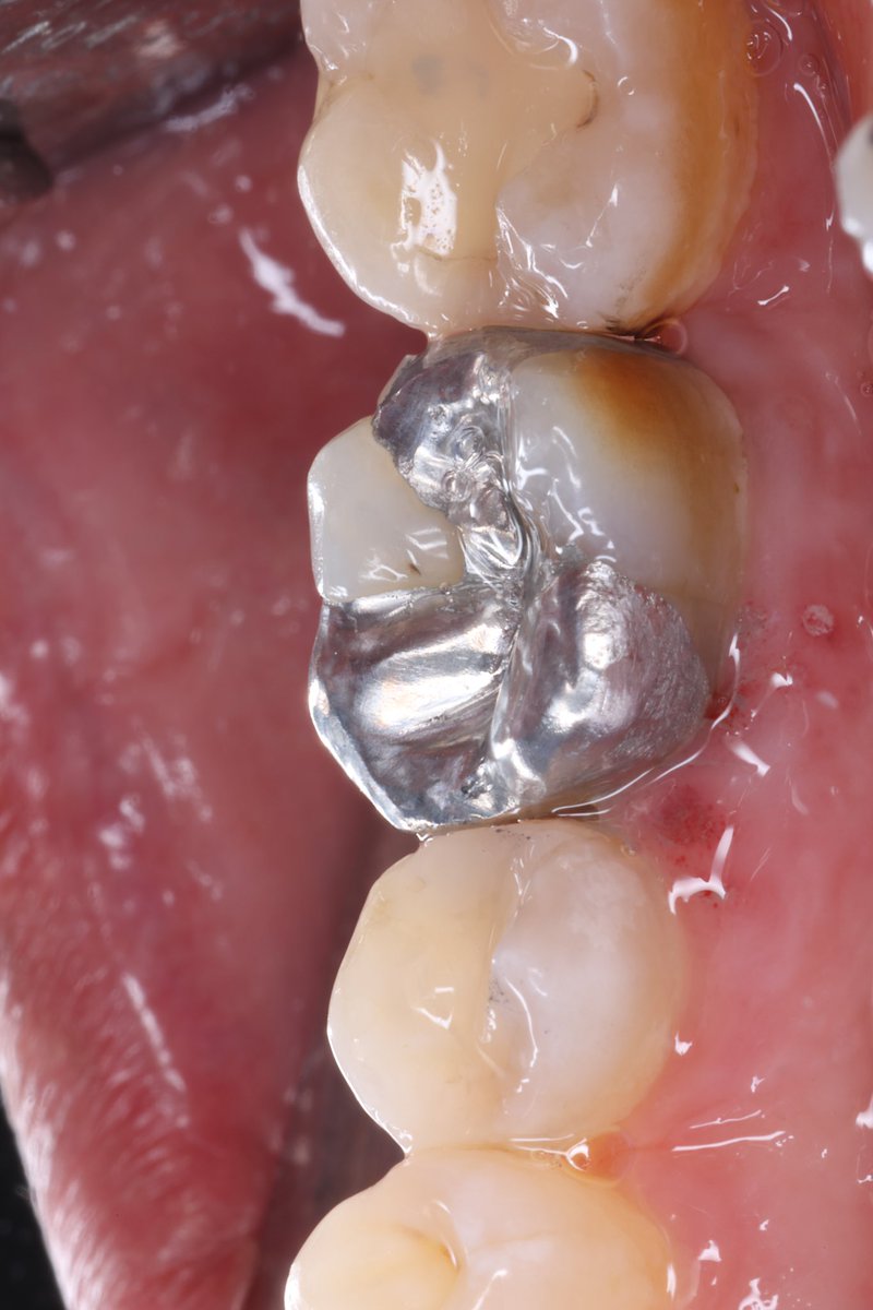 Complex amalgam