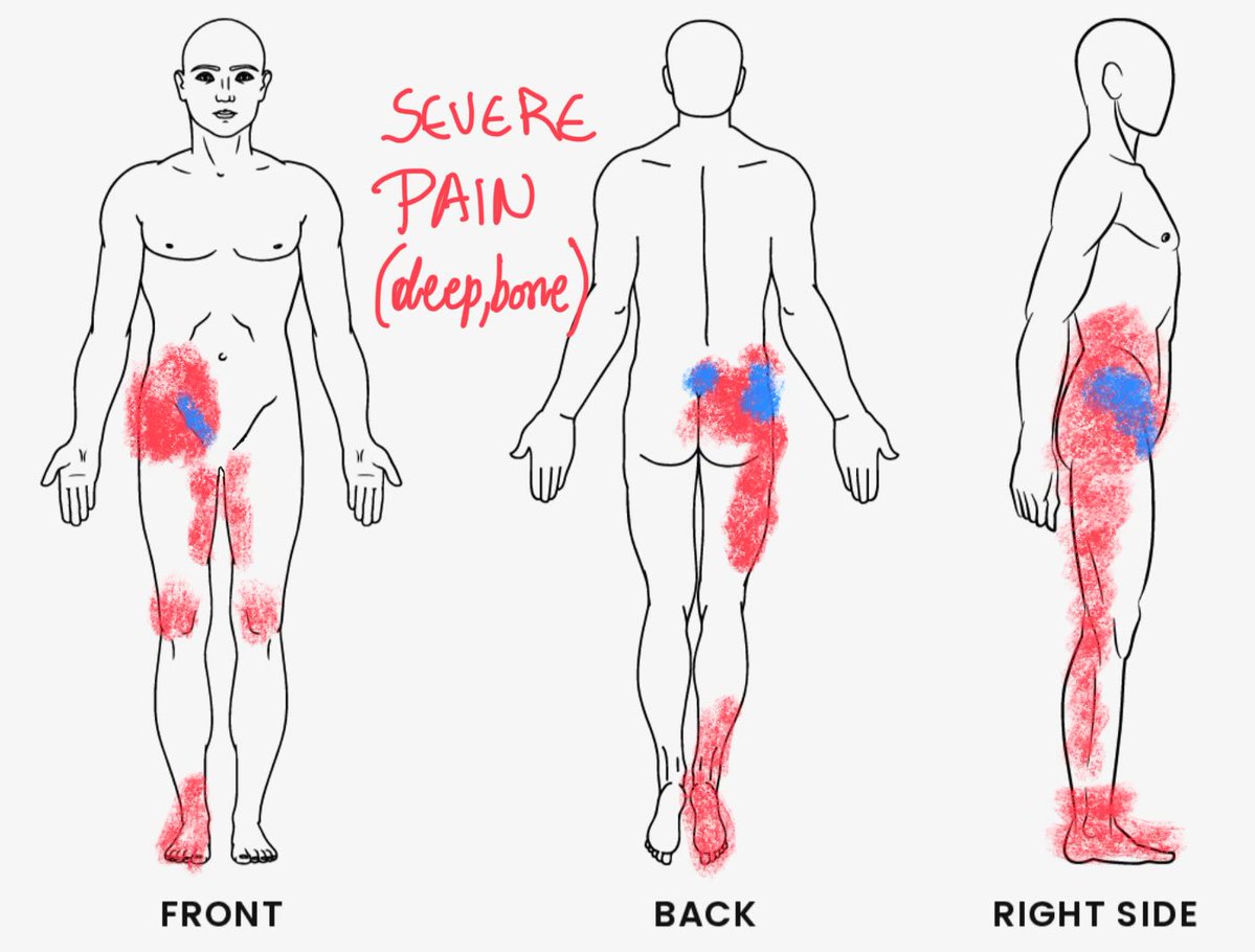 katiamek's tweet image. I literally don’t feel my leg from the severe deep bone pain and everything. And this is only one symptoms. This is a nightmare. #pwme #mecfs #longcovid