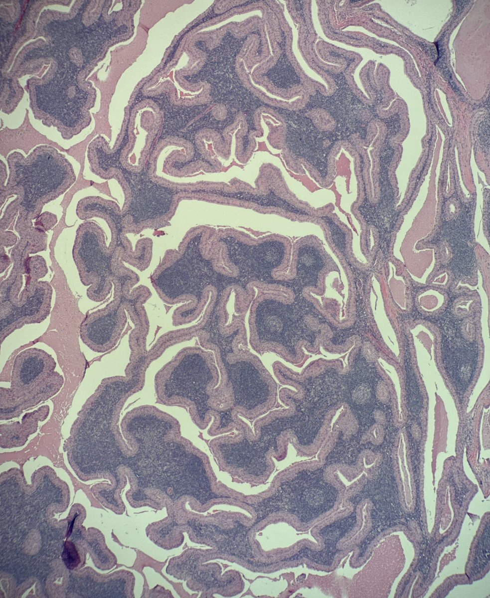 A really photogenic Warthin tumor
#PathTwitter #PathX