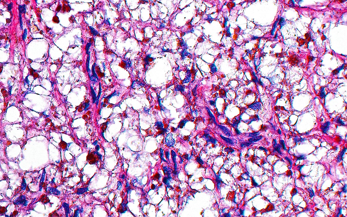 ziad_zaatari's tweet image. 🔬📸👨‍🎨 Like another Jackson Pollock painting! 

~ Lipid (white), fibers and vessels (pink) and bile pigment (yellow-brown dots)...in Xanthogranulomatous Cholecystitis ~ 

#Pathology #GIpath #PathArt
