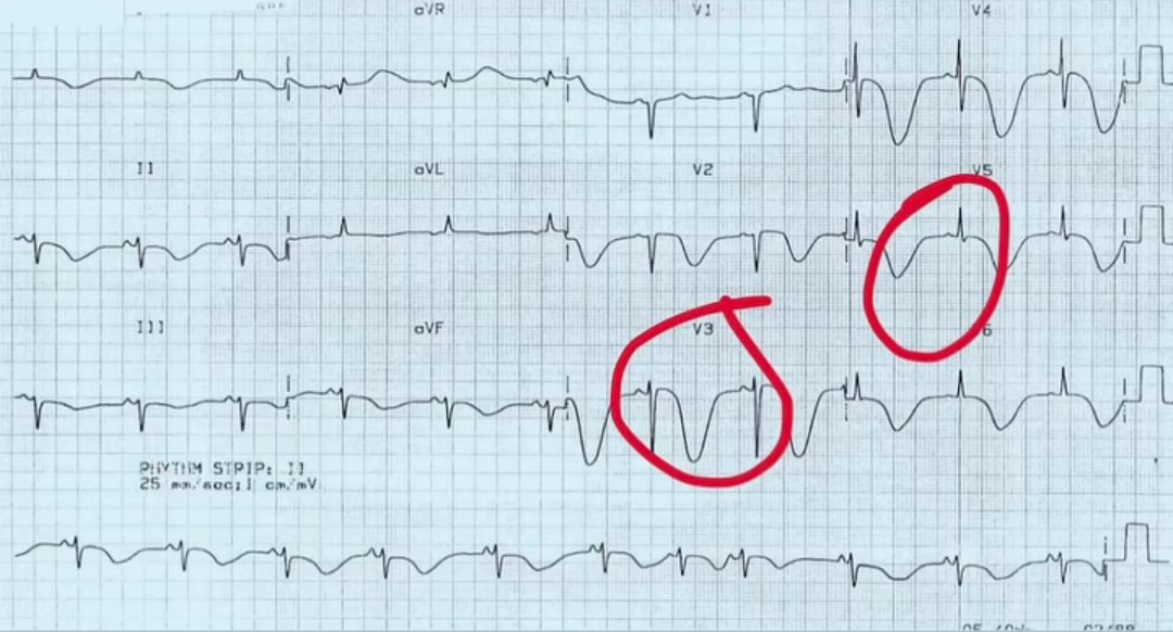 ECG shows massive T-wave inversions.
Troponins: normal.
Chest pain: none.
But the patient collapsed 20 minutes ago after a sudden, thunderclap headache.

What are you thinking?