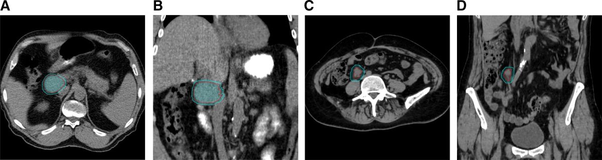 Applied_RadOnc's tweet image. Planning Target Volume Margin Assessment of Retroperitoneal Tumors Using Robotic SBRT With Spine Tracking

Learn more 🔗  zurl.co/9x6KF 

#radonc #radonced #radiationoncology