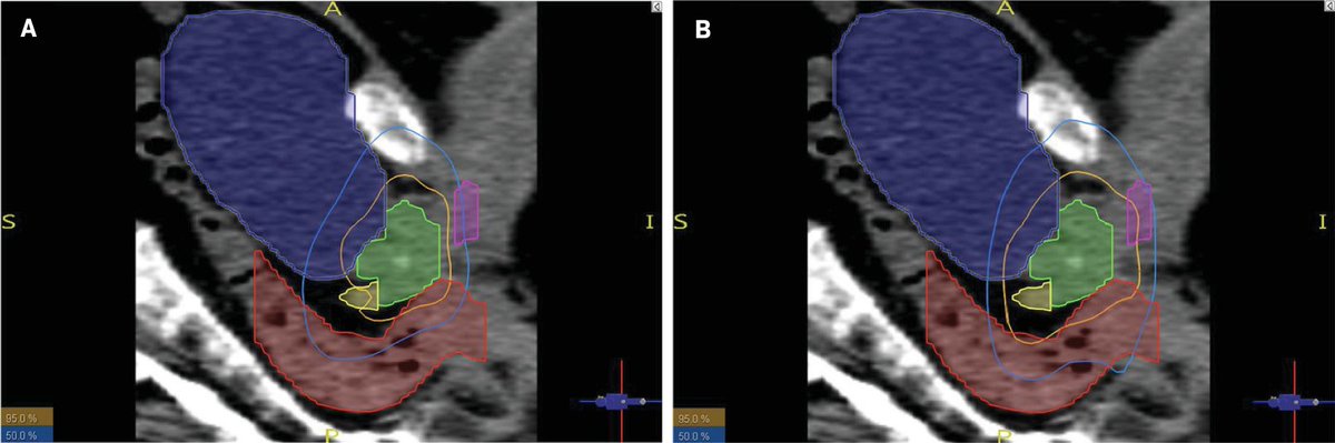 Applied_RadOnc's tweet image. ✨ In case you missed it!

This week we’re highlighting the 5 most popular posts from November  — the stories you read, shared, and engaged with the most.

4️⃣ zurl.co/bAh2y  | CHHiP vs PROFIT for Localized Prostate Cancer: A Retrospective Dosimetric Comparison of Organs…