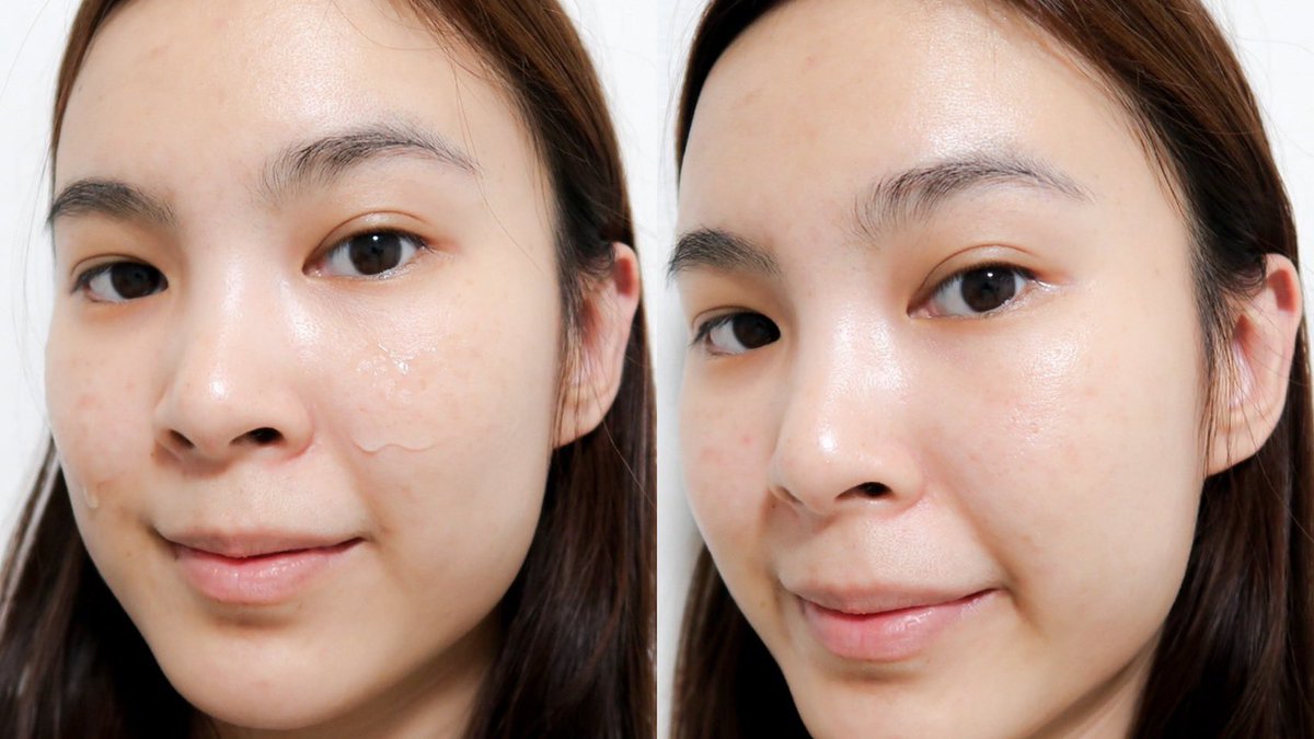 jellllnrr's tweet image. เคยคิดว่าเซรั่มลดสิวต้องแห้งตึงแน่ ๆ แต่ตัวนี้คือเบา ไม่มัน ไม่เหนอะ ผิวดูใสขึ้นแบบไม่รู้ตัว ใครมีสิวผด สิวอุดตัน ลองได้เลย ไม่ระคายผิว แล้วเค้าช่วยให้ผิวชุ่มชื้นอีกด้วย ส่วนตัวใช้แล้วชอบเลย

📍พิกัด : s.shopee.co.th/gHmc8nxUU 

#ป้ายยาสกินแคร์ #skincareroutine #BrightandBloom…