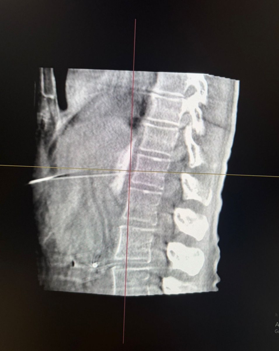 Celiac plexus neurolysis for palliation of pain