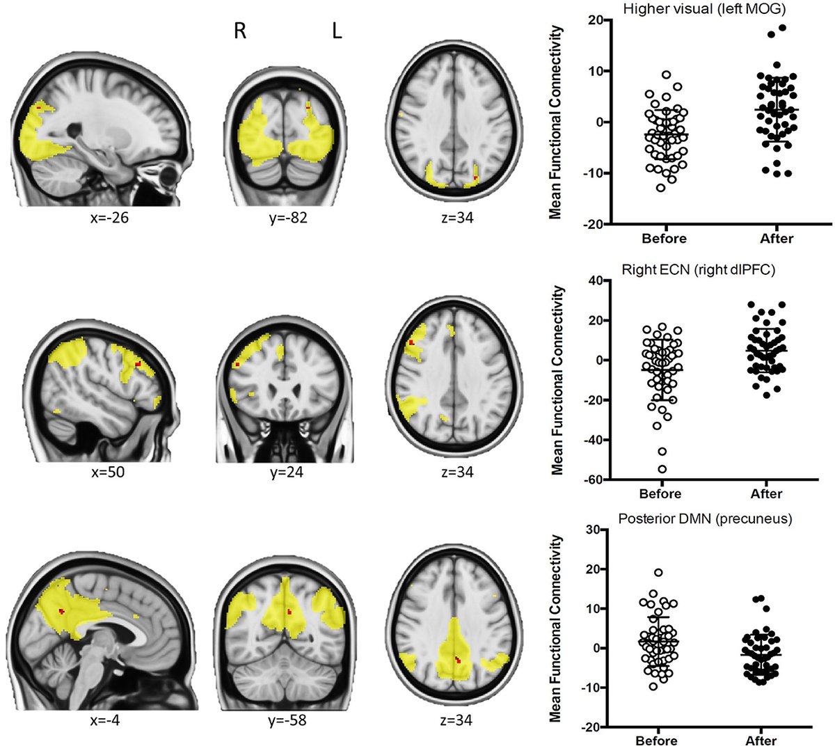 BrandonLuuMD's tweet image. Drinking coffee reduces connectivity in the posterior default mode network, a region involved in mind-wandering and self-focused thought