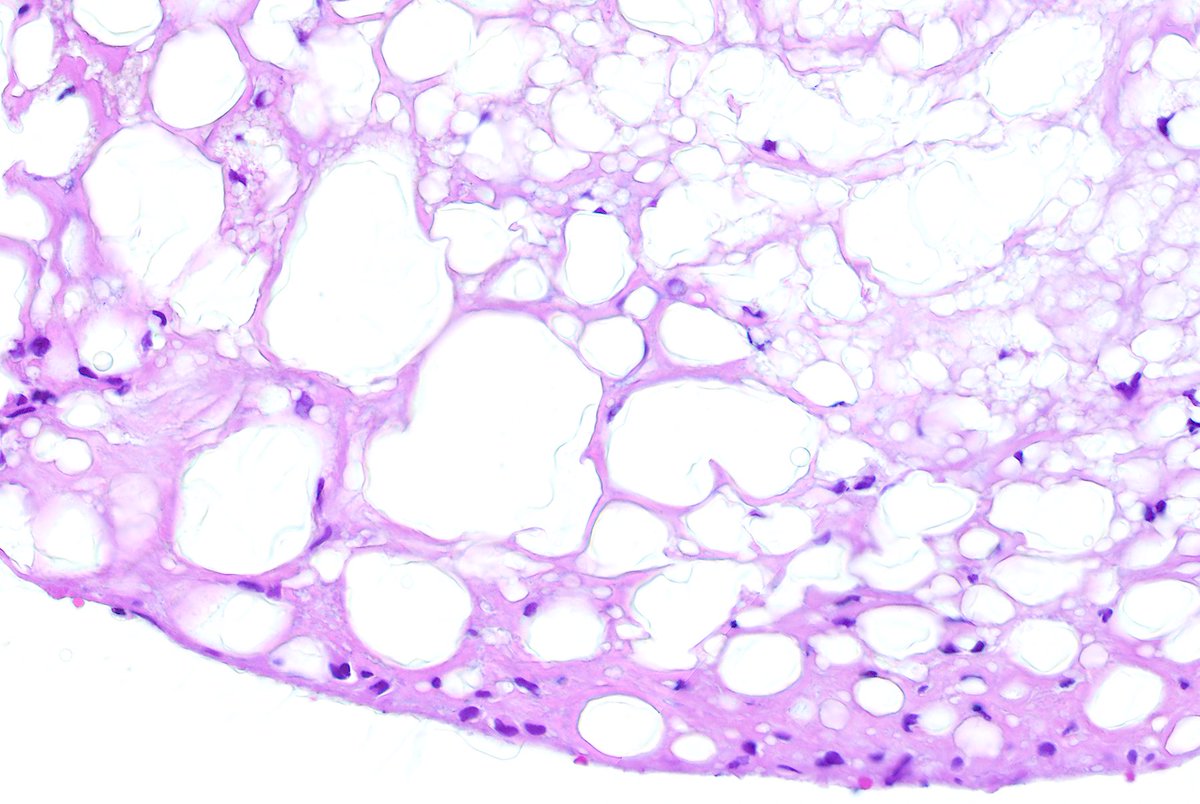 tlabiano's tweet image. 👙🎈💥🌋👩🏻‍🔧🔬Silicone breast implant rupture removal with reactive synovial metaplasia and  giant cells reaction against silicone 
 #breastpath #beautyinroutine #funinroutine #tuesdaymotivation