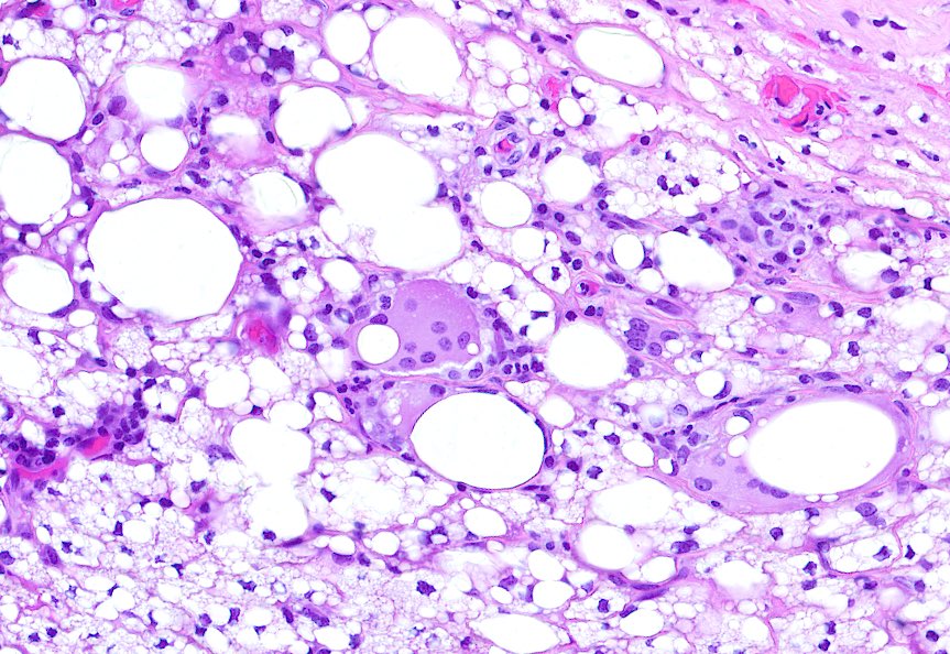 tlabiano's tweet image. 👙🎈💥🌋👩🏻‍🔧🔬Silicone breast implant rupture removal with reactive synovial metaplasia and  giant cells reaction against silicone 
 #breastpath #beautyinroutine #funinroutine #tuesdaymotivation