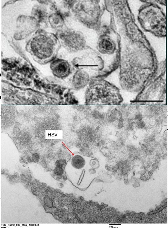 Top: Image of claimed "Herpes Simplex Virus" from a Published Peer Reviewed Paper

Bottom: Image of Identical shaped, sized and Inclusions to claimed "HSV" in an uninfected culture that could not possibly contain a "Virus"